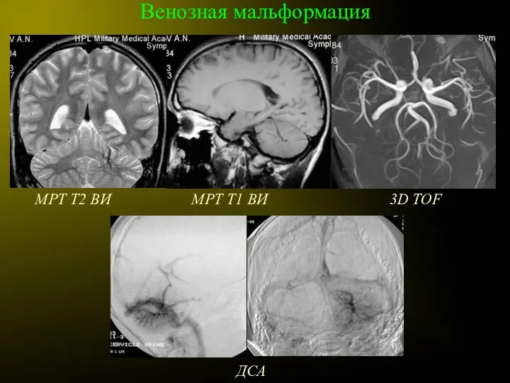 Венозная мальформация МРТ Т2 ВИ МРТ Т1 ВИ 3D TOF ДСА