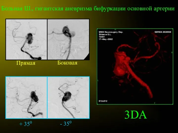 Больная Ш., гигантская аневризма бифуркации основной артерии Прямая Боковая + 350 - 350 3DA