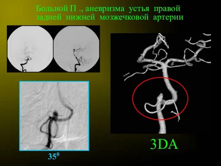 Больной П ., аневризма устья правой задней нижней мозжечковой артерии 350 3DA