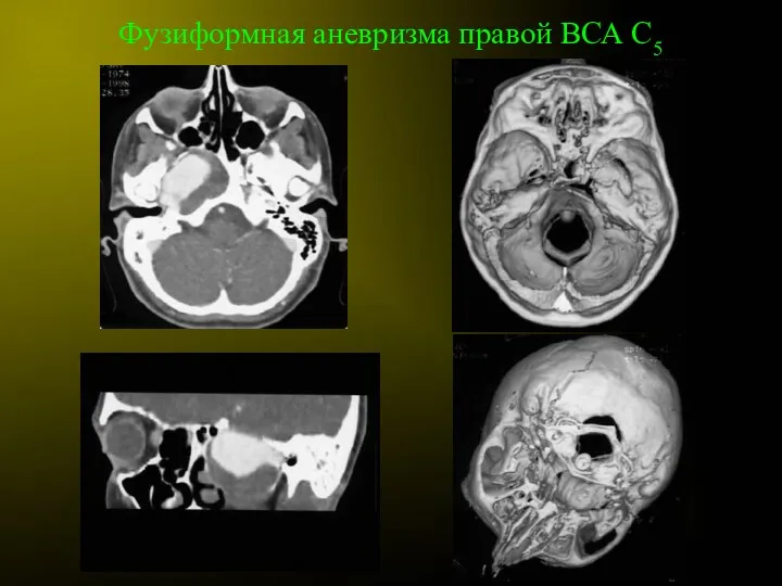 Фузиформная аневризма правой ВСА С5