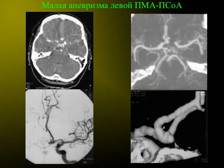 Малая аневризма левой ПМА-ПСоА