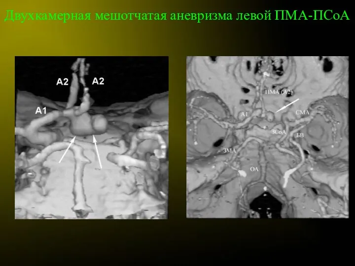 Двухкамерная мешотчатая аневризма левой ПМА-ПСоА