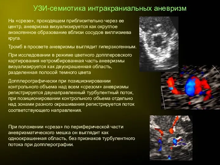 УЗИ-семиотика интракраниальных аневризм На «срезе», проходящем приблизительно через ее центр,