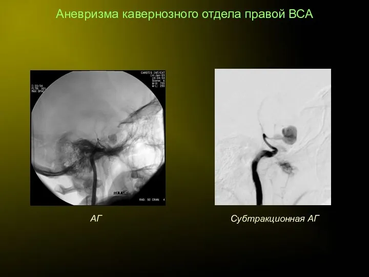 Аневризма кавернозного отдела правой ВСА АГ Субтракционная АГ