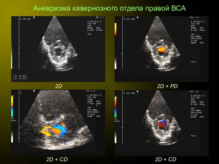 Аневризма кавернозного отдела правой ВСА 2D 2D + PD 2D + CD 2D + CD