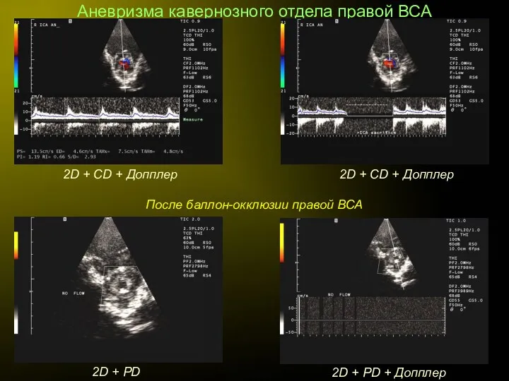 Аневризма кавернозного отдела правой ВСА 2D + CD + Допплер