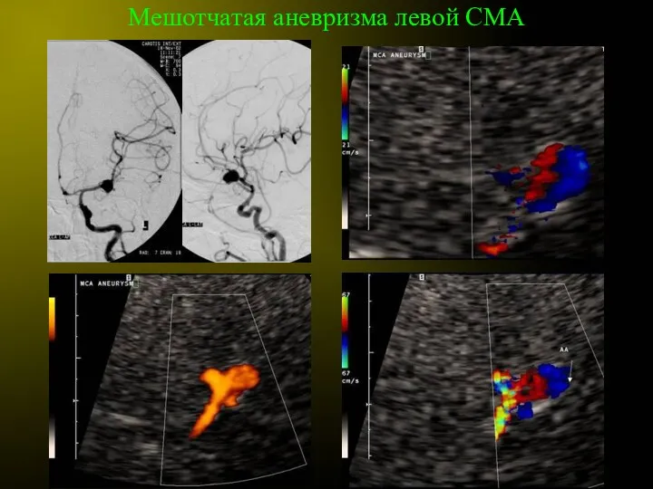 Мешотчатая аневризма левой СМА