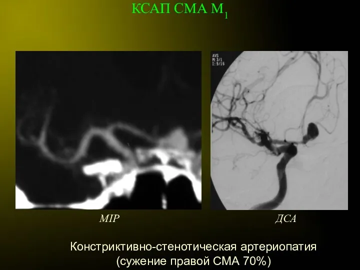 Констриктивно-стенотическая артериопатия (сужение правой СМА 70%) MIP ДСА КСАП СМА М1