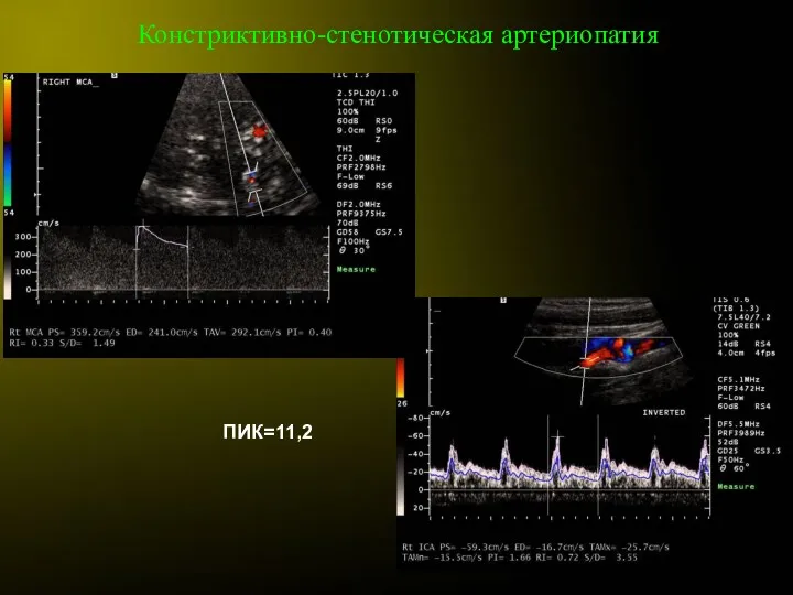 Констриктивно-стенотическая артериопатия ПИК=11,2