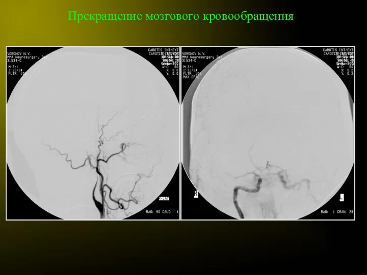 Прекращение мозгового кровообращения