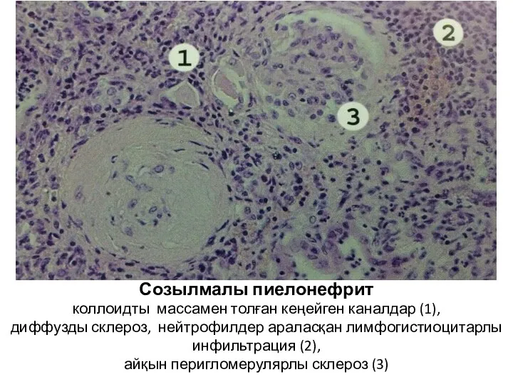 Созылмалы пиелонефрит коллоидты массамен толған кеңейген каналдар (1), диффузды склероз,