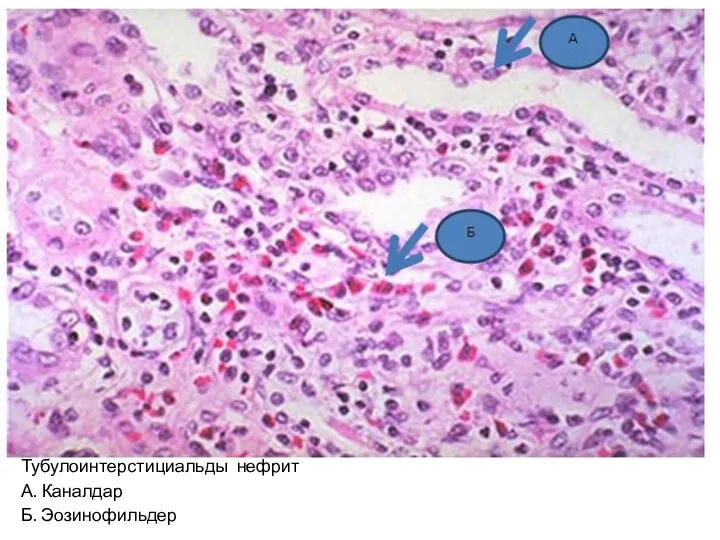 Тубулоинтерстициальды нефрит А. Каналдар Б. Эозинофильдер