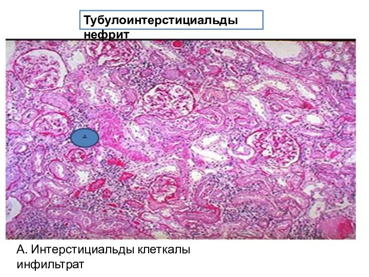 Тубулоинтерстициальды нефрит А. Интерстициальды клеткалы инфильтрат