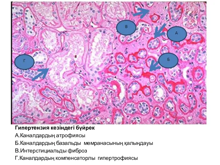 Гипертензия кезіндегі бүйрек А.Каналдардың атрофиясы Б.Каналдардың базальды мемранасының қалыңдауы В.Интерстициальды фиброз Г.Каналдардың компенсаторлы гипертрофиясы
