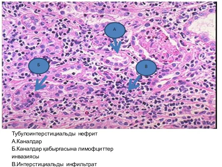 Тубулоинтерстициальды нефрит А.Каналдар Б.Каналдар қабырғасына лимофциттер инвазиясы В.Интерстициальды инфильтрат