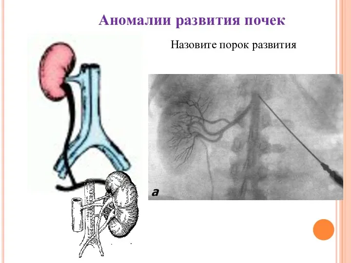 Аномалии развития почек Назовите порок развития