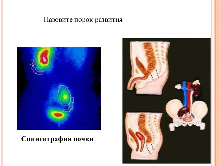 Сцинтиграфия почки Назовите порок развития