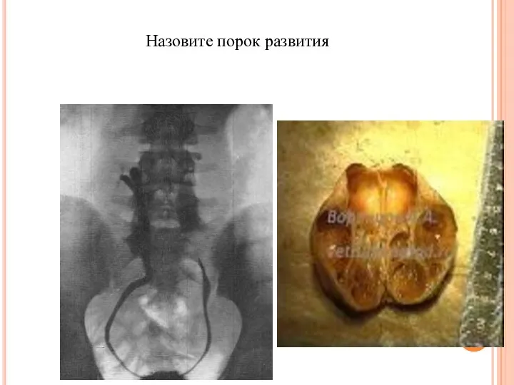 Назовите порок развития