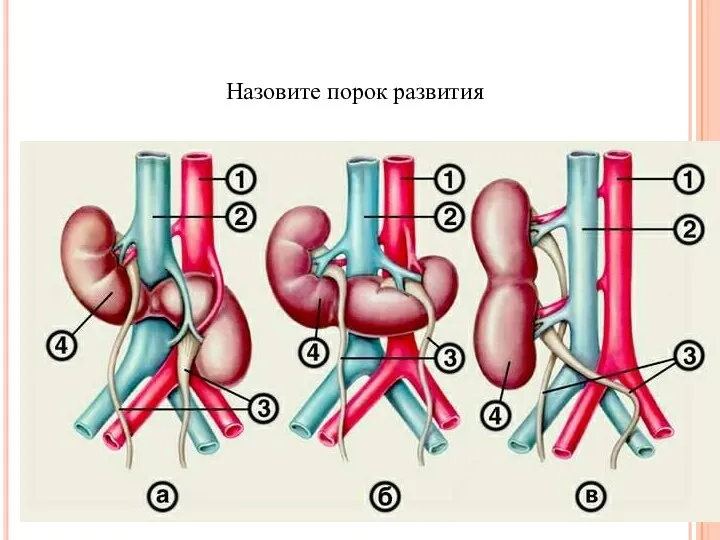 Назовите порок развития