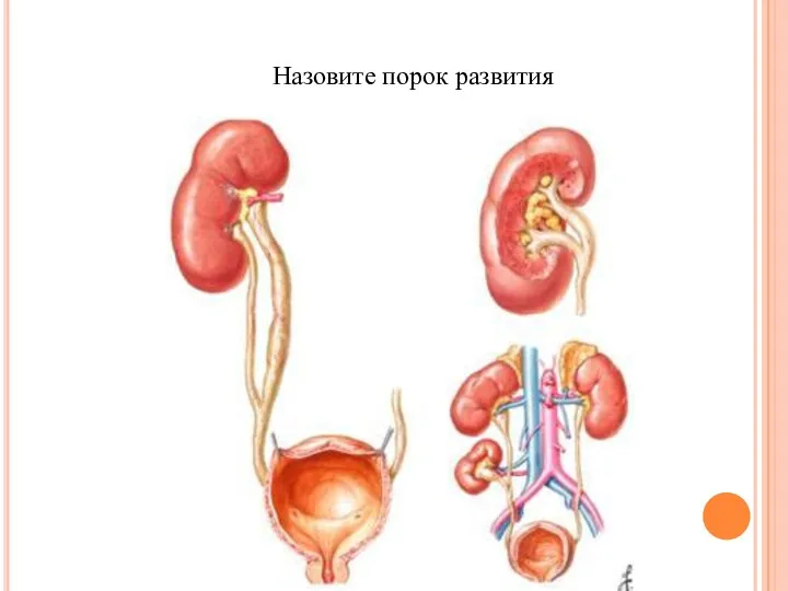 Назовите порок развития