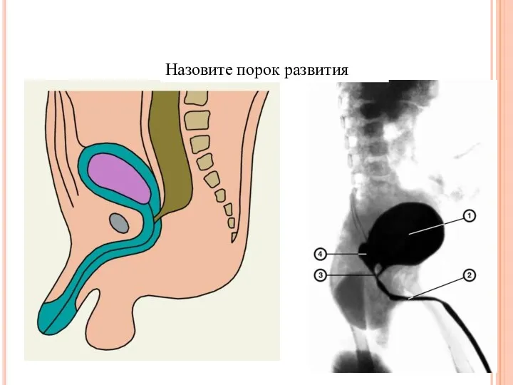 Назовите порок развития