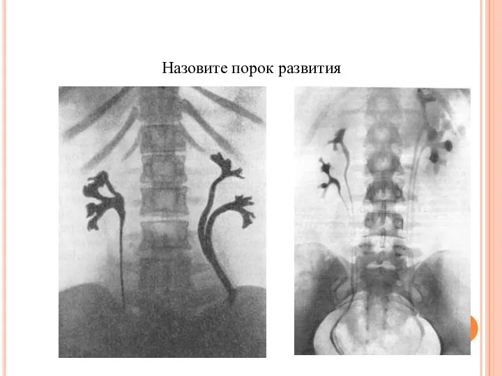 Назовите порок развития