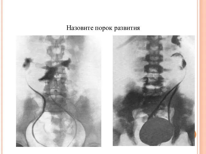 Назовите порок развития