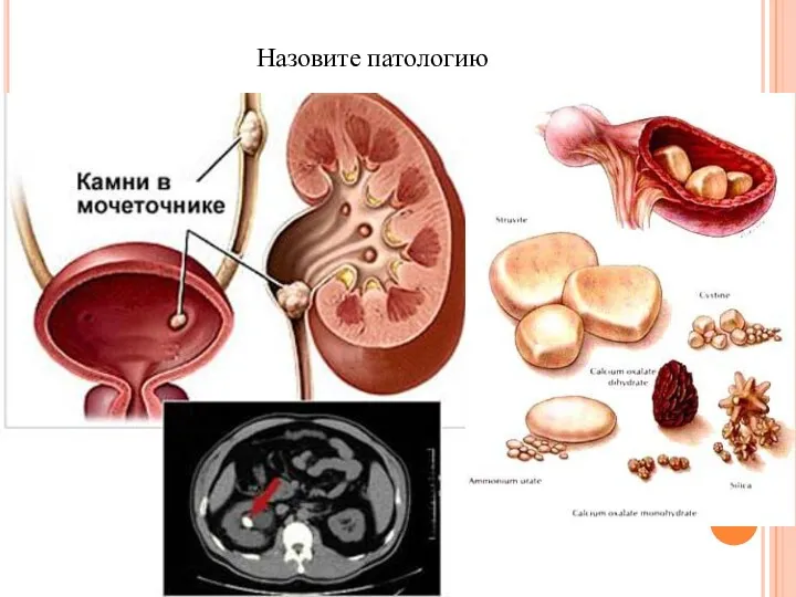 Назовите патологию
