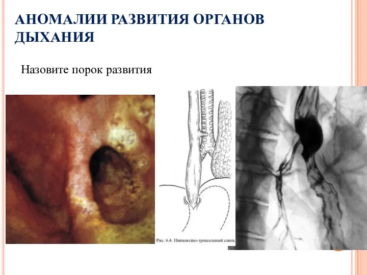 АНОМАЛИИ РАЗВИТИЯ ОРГАНОВ ДЫХАНИЯ Назовите порок развития