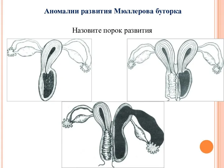 Аномалии развития Мюллерова бугорка Назовите порок развития