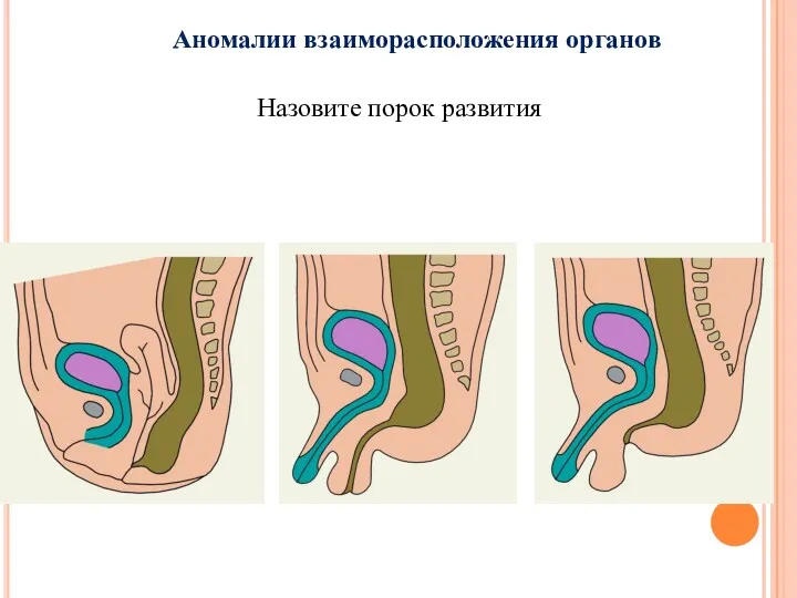 Аномалии взаиморасположения органов Назовите порок развития