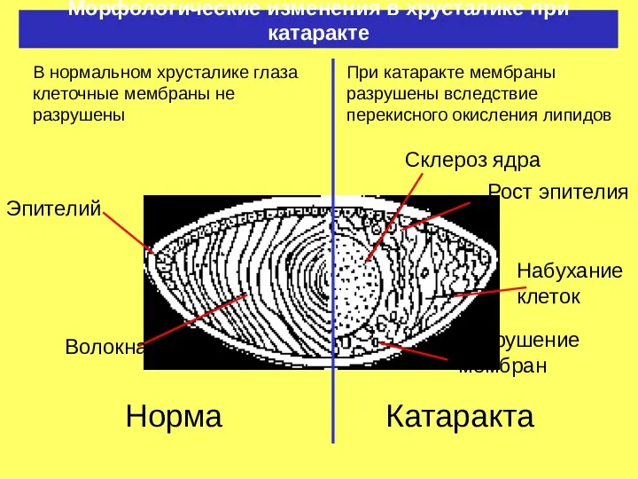 Морфологические изменения в хрусталике при катаракте Норма Эпителий Волокна Склероз