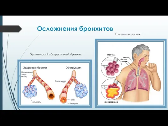Осложнения бронхитов Пневмония легких Хронический обструктивный бронхит