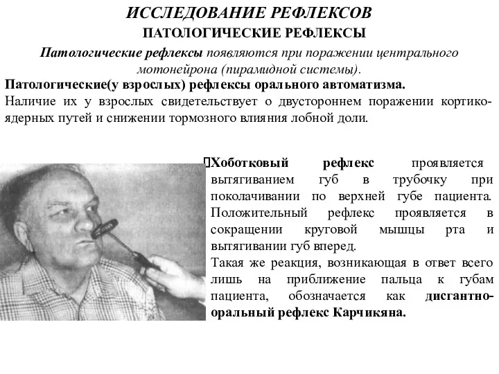 ИССЛЕДОВАНИЕ РЕФЛЕКСОВ Патологические рефлексы появляются при поражении центрального мотонейрона (пирамидной системы). ПАТОЛОГИЧЕСКИЕ РЕФЛЕКСЫ