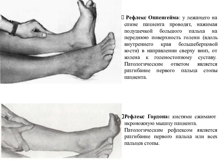 Рефлекс Оппенгейма: у лежащего на спине пациента проводят, нажимая подушечкой большого пальца на