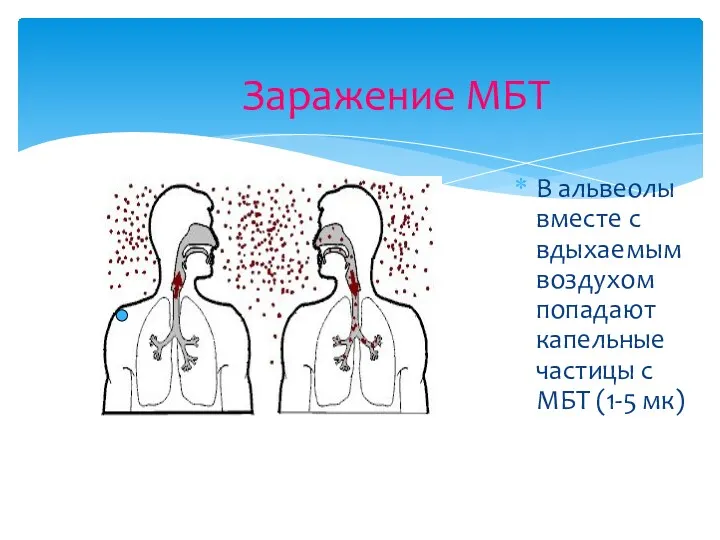 Заражение МБТ В альвеолы вместе с вдыхаемым воздухом попадают капельные частицы с МБТ (1-5 мк)