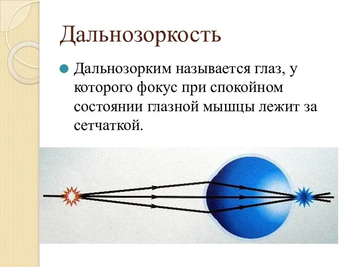 Дальнозоркость Дальнозорким называется глаз, у которого фокус при спокойном состоянии глазной мышцы лежит за сетчаткой.