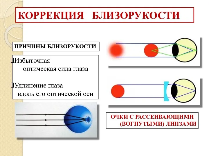 КОРРЕКЦИЯ БЛИЗОРУКОСТИ ПРИЧИНЫ БЛИЗОРУКОСТИ Избыточная оптическая сила глаза Удлинение глаза