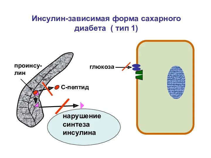 глюкоза С-пептид проинсу-лин Инсулин-зависимая форма сахарного диабета ( тип 1) нарушение синтеза инсулина