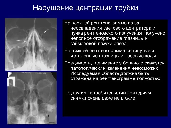 Нарушение центрации трубки На верхней рентгенограмме из-за несовпадения светового центратора и пучка рентгеновского