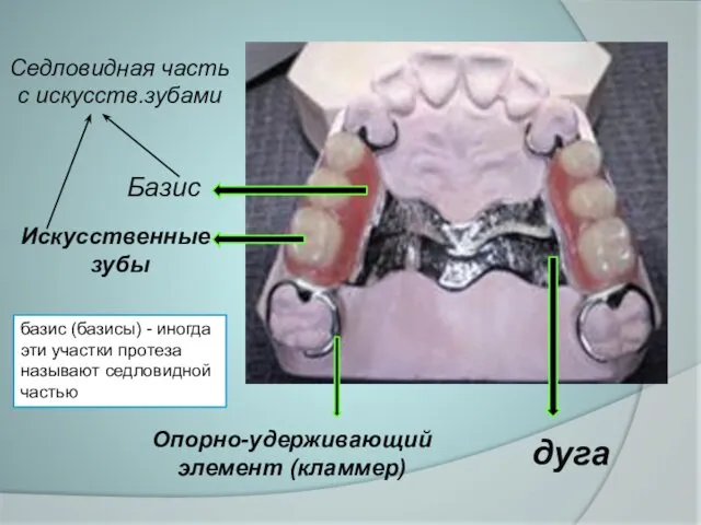 Искусственные зубы Базис Опорно-удерживающий элемент (кламмер) дуга Седловидная часть с