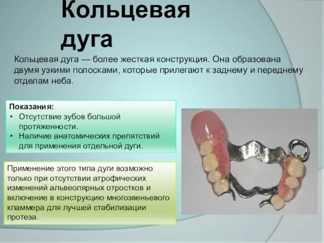 Кольцевая дуга Кольцевая дуга — более жесткая конструкция. Она образована