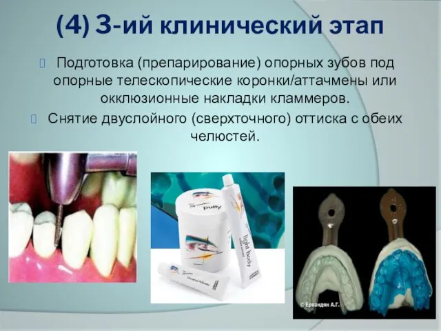 (4) 3-ий клинический этап Подготовка (препарирование) опорных зубов под опорные