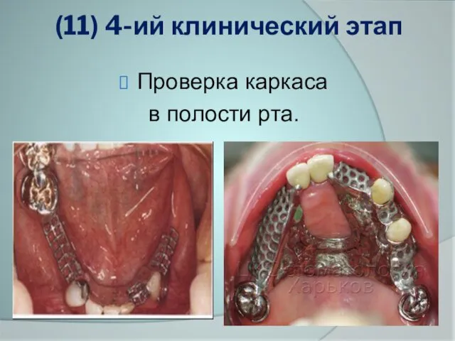 (11) 4-ий клинический этап Проверка каркаса в полости рта.