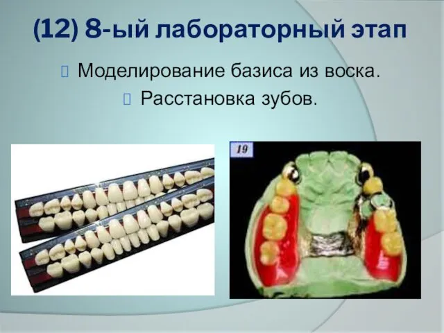 (12) 8-ый лабораторный этап Моделирование базиса из воска. Расстановка зубов.