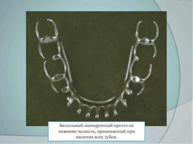Бюгельный шинирующий протез на нижнюю челюсть, применяемый при наличии всех зубов.