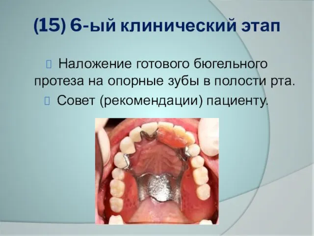 (15) 6-ый клинический этап Наложение готового бюгельного протеза на опорные