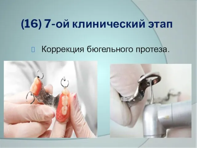 (16) 7-ой клинический этап Коррекция бюгельного протеза.