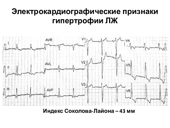 Электрокардиографические признаки гипертрофии ЛЖ Индекс Соколова-Лайона – 43 мм