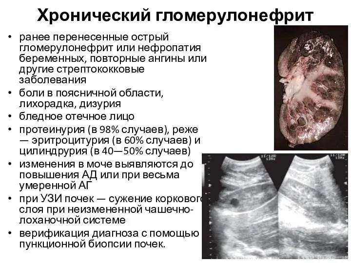 Хронический гломерулонефрит ранее перенесенные острый гломерулонефрит или нефропатия беременных, повторные ангины или другие